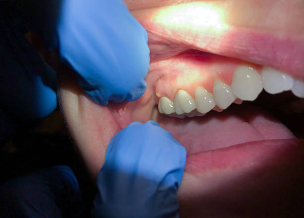 Best Broken or Cracked Tooth Emergency Dentist in Tuscarawas, OH